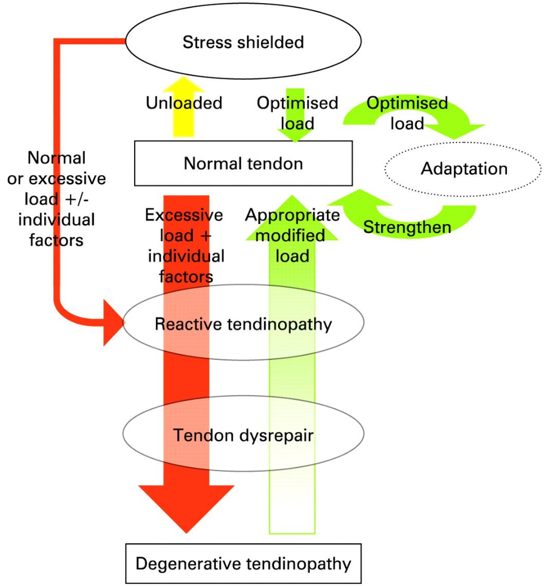 Tendon pain: A symptom of failed loading teaser image